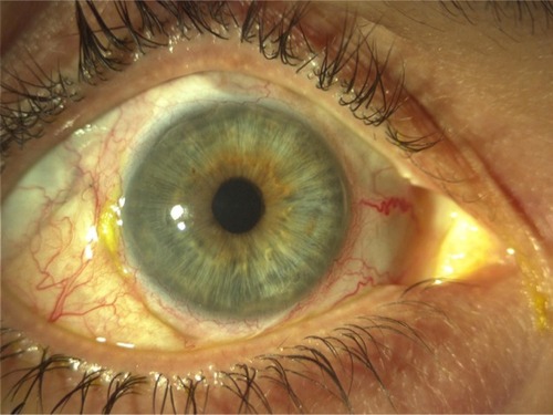 Figure 2 Anterior segment image of the right eye 3 weeks postoperatively.