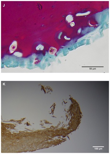 Figure 2 (A) Filament cross, oblique, and lateral sections, from a specimen collected from patient 1 showing round, elliptical/elongated, bean-like, or curved morphology. Note the hollow medulla and surrounding cortex. Cytokeratin (CK) AE1/AE3 staining. 100× magnification. (B) Specimen from patient 1, demonstrating irregular, patchy keratin staining with CK AE1/AE3, longitudinal section. Note most filaments staining positive for keratin (dark brown). 100× magnification. (C) Specimen from patient 1, demonstrating irregular, patchy keratin staining with CK AE1/AE3. Cross, oblique, and longitudinal sections. Note most filaments staining negatively for keratin. 400× magnification. (D) Longitudinal section of filament from patient 1. Note retained nuclei, central medulla, and patchy keratin staining with CK AE1/AE3. 400× magnification. (E) Sectioned filament from a specimen from patient 1, which upon gross microscopic examination demonstrated floral-like or stellate formations. Note retained nuclei within tentacle-like filaments with tapered ends. CK AE1/AE3 staining. 400× magnification. (F) Sectioned callus from patient 1, showing filaments stemming from the stratum basale with evolution inwards towards the dermis. Note filament sections with hollow medulla alongside the stratum basale. CK AE1/AE3 staining. 100× magnification. (G) Gömöri trichrome collagen-positive section of activated fibroblasts with filamentous inclusions from patient 2. Collagen stains green, keratin stains red. Growth of filaments was upwards toward the external surface. 400× magnification. (H) Ruptured keratin projection from both external and internal surfaces from a specimen collected from patient 2, with areas of fibroblast proliferation stained green. Gömöri trichrome stain. 100× magnification. (I) Section from patient 2 stained with Gömöri trichrome, demonstrating both keratin (red) and collagen (green) filament cross-sections, with most filaments associated with the external callus surface. 100× magnification. (J) Gömöri trichrome stain of specimen from patient 2, demonstrating filaments in longitudinal, oblique, and cross-sections close to and within collagen-positive fibroblast collections (green). Note presence of filament cross-sections staining positively for keratin (red). 400× magnification. (K) Bovine digital dermatitis (BDD) filament, longitudinal section, showing positive CK AE1/AE3 staining. 100× magnification. (L) BDD filament, longitudinal section, showing negative CK AE5/AE6 staining. 100× magnification.