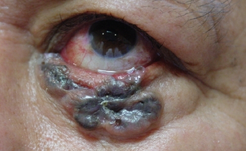 Figure 2 Pigmented, raised lesion encompassing right lower lid with areas of ulceration and madarosis, infiltrating the lid margin.