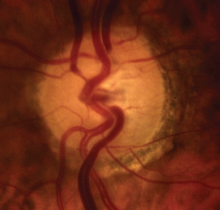 Figure 1 Optic disc and peripapillary atrophy.