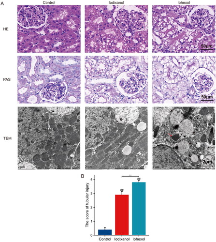 Figure 3. In the novel CI-AKI rat model, iodixanol induces more severe morphological damage than iodixanol. (A) Hematoxylin and eosin (HE) stain, scale bar, 50 μm; Periodic acid-Schiff (PAS) staining, scale bar, 50 μm; Transmission Electron Microscope (TEM), scale bars, 2 μm, representative photomicrographs of mitochondrial reduction, mitochondrial swelling, loss of cristae (red arrow), and vacuolization in the matrix (black triangle arrow) were observed in iohexol groups. (B) Quantitative analysis of histologic scoring. (##p < 0.01 vs. group control, **p < 0.01 vs. group iodixanol).
