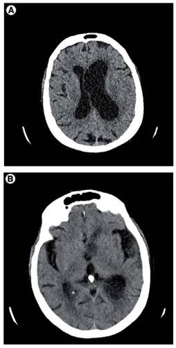 Figure 1. Axial non-contrast CT brain.(A) Showing prominence of the ventricles with marked asymmetrical dilatation of the left lateral ventricle. (B) Layering of debris within the occipital horns.