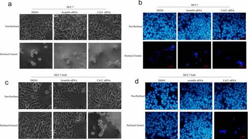 Figure 4. CA12-siRNA transfection combined with paclitaxel induces apoptosis of MCF-7 TaxR cells. (a) Morphological observation of MCF-7 cells after siRNA transfection; (b) Hoechst 33,342 fluorescence staining observation of MCF-7 cells after siRNA transfection;(c) Morphological observation of MCF-7 TaxR cells after siRNA transfection; (d) Hoechst 33,342 fluorescence staining observation of MCF-7 TaxR cells after siRNA. Scale bar,100 μM