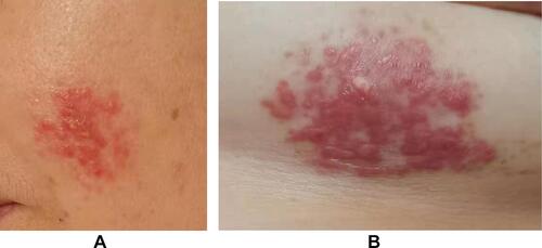 Figure 5 Three months after diagnosis, skin lesions partially disappeared. (A) Papules on the left cheek disappeared, but erythema (approximately 3 cm × 3 cm) is noted. (B) Papules on left chest were smaller in size (approximately 5 cm × 3 cm).