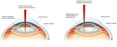 Figure 1 Schematic representation of the eye with application of the Nd: YAG laser beam. Correctly focused on the posterior capsule (left) and incorrectly focused (right) with creation of a defect on the intraocular lens.