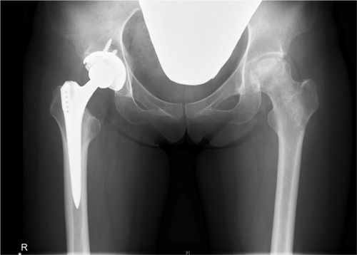Figure 4 Anterior–posterior radiograph of bilateral hips demonstrating cementless right total hip arthroplasty and left joint preservation following the surgery of core decompression and autologous bone graft.