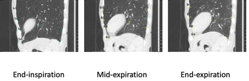 Figure 7 Example images on the median sagittal plane for the left lower lung field for three intermittent time frames in a non-smoker. Median sagittal images for the lower lung field at three intermittent time frames in an 82-year-old female non-smoker demonstrate almost comparable movements in the non-dependent pleural aspect compared with the dependent pleural aspect. The MPMVND/D in this case had a negative value of −1.24. Colors of some measurement points on the pleural aspect or lung field center at end-inspiration changed from blue to yellow at mid-inspiration and end-expiration, which means that these yellow points were located outside the displayed median sagittal plane owing to regional lateral movement.