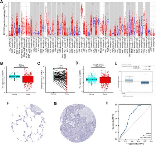 Figure 1 Comparison of SNX20 expression levels in different types of tumor tissues and normal tissues (A) Results of the analysis of SNX20 expression levels in TIMER database. (B–D) Comparative results of normal and LUAD tissues in TCGA combined with GTEx database. (E) Box plot showing the expression of SNX20 mRNA in the Oncomine dataset. (F and G) Comparison of SNX20 gene expression in immunohistochemical images of normal and tumor tissues in HPA. (H) ROC curves were established to test the value of SNX20 to identify LUAD tissues. (*P < 0.05, **P < 0.01, ***P < 0.001).