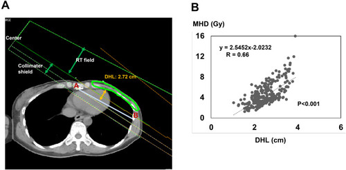 Figure 2 Relationship between MHD and the distance of heart (DHL) for left-sided breast cancer patients. (A) Representative images of the distance of heart (DHL) is shown (A: the midline of the sternum; B: the left middle axillary line; DHL: orange; PTV: light green). (B) The values of DHL plotted against mean heart dose. DHL indicated good positive linear correlation with mean heart dose for all patients.