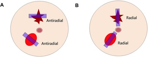 Figure 2 Image acquisition directions for the breast lesions. (A) Antiradial plane; (B) radial plane.