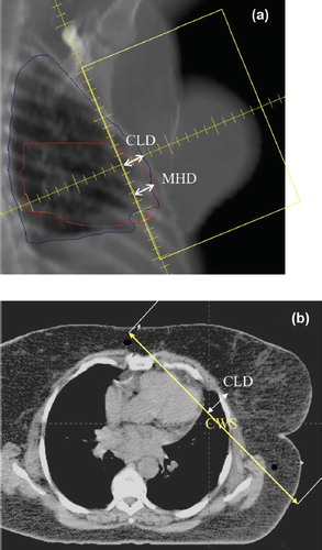 Figure 1. a, b. Description of various breast treatment parameters, CLD, CWS and MHD.