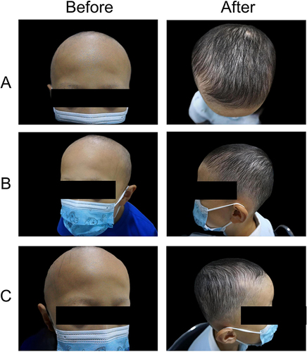 Figure 4 Photographs of a representative patient in the MN group: panel A-C showed different regions of scalp before and after treatment ((A) top, (B) left side, (C) right side).
