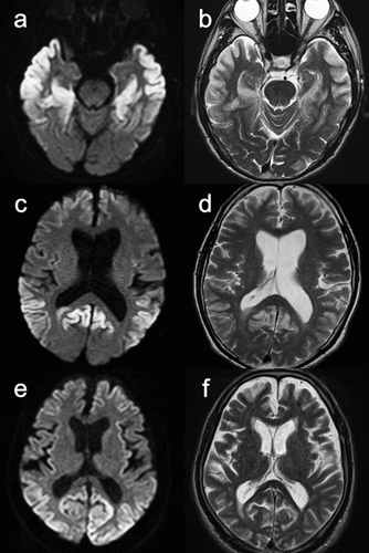 Figure 1. Magnetic resonance imaging (MRI) of an 80-year-old male with V180I (a – d) and an 84-year-old male with sporadic Creutzfeldt – Jakob disease (sCJD) (e, f). Brain MRI revealed increased signal intensity in the cerebral cortices on diffusion-weighted imaging in patients with both V180I CJD (a, c) and sCJD (e). Increased signal intensity in the cerebral cortices was also observed on T2-weighted images, with swelling in one patient with V180I CJD (b, d) and no swelling in one patient with sCJD (f).
