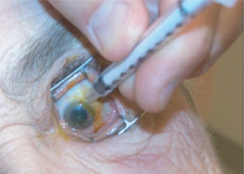 Figure 6c The injection site 3–4 mm posterior to limbus is marked using the end of a TB syringe. This ensures that the injection will be given through the pars plana. An injection given more anterior may result in hemorrhage due to trauma to the highly vascularized pars plicata. An injection given more posterior may result in retinal detachment.