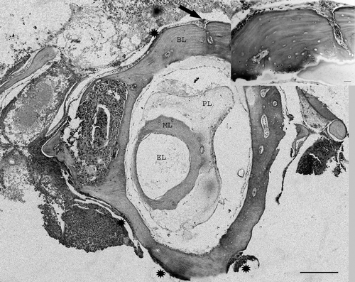 Figure 3.  Magnified view of Figure 1. Semicircular canal with inflammation of bony labyrinth and well preserved membranous labyrinth. Several degrees of periostitis (asterisks) with inflammation penetrating through blood vessels can be seen (arrow). Inset: detail of periostitis penetrating the bone. Bar = 20 µm. BL, Bony labyrinth; PL, perilymph; ML, membranous labyrinth; EL, endolymph. Haematoxylin and eosin. Bar = 200 µm.