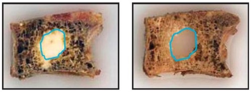 Figure 6 Balloon kyphoplasty sectioned specimen demonstrates notably less interdigitation of bone cement outside the larger surgically created cavity (left) and increased loss of peripheral trabecular bone after polymethylmethacrylate dissolution (right).