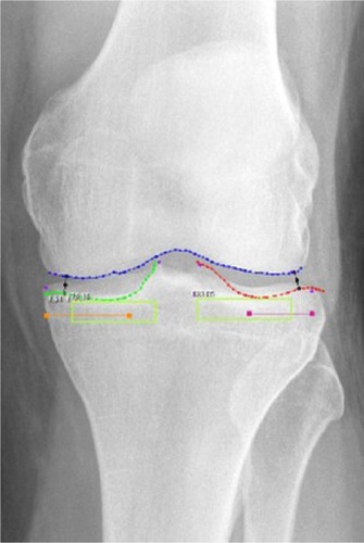 Figure 2 Semiautomated regions of interest by KneeAnalyzer.Notes: Joint space boundary profiles for femur (blue); Joint space boundary profiles for tibial plateau at both the lateral compartment (red) and the medial (green) compartments; Regions for fractal signature analysis in the medial and lateral subchondral bone (light green boxes); Minimum joint width at the lateral compartment and the medial compartments (black).