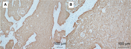 Figure S2 Representative immunohistochemical staining of p16 in ASCC patient samples.Note: Original magnification: ×100 (A) and ×200 (B).Abbreviation: ASCC, anal squamous cell carcinoma.