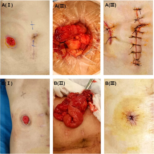 Figure 2. Preoperative, intraoperative and postoperative pictures (I, II, and III) of stoma reversal surgery. (A) The end stoma closer (ESC). (B) The split stoma reversal (SSR).