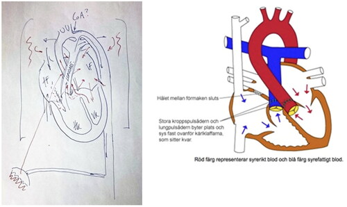 Figure 7. A hand-drawn and digital medical image of a heart defect juxtaposed