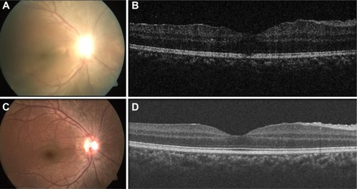 Figure 2 Fundus pictures and OCT images of early stage and chronic stage of the disease.