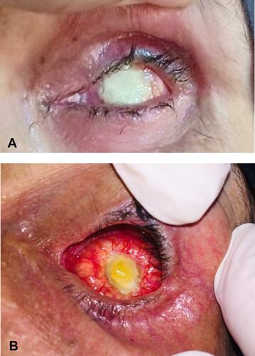 Figure 7 (A) Postoperative photograph shows persistent white color of the dermal surface after electrocoagulation at postoperative week 8 that ended up with persistent ulcer (B). Excision with amniotic membrane transplantation was performed for this patient.