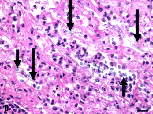 Figure 8.  Tongue, Eclectus parrot (E. roratus). Fibrinous and heterophilic inflammation with moderate numbers of 2 to 4 µm, basophilic to amphophilic, extracellular yeasts (short arrows) and occasional, slender, 4 to 6 µm wide, basophilic to amphophilic, parallel-walled, irregularly septated fungal hyphae (long arrows) (C. albicans). HE. Bar=10 µm.