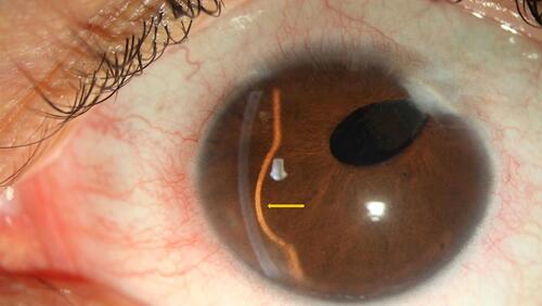 Figure 1 Slit-lamp photograph of the left eye showing opacity in cornea incision site with aphakia. The yellow arrow shows remarkable iris bulging in inferonasal quadrant.