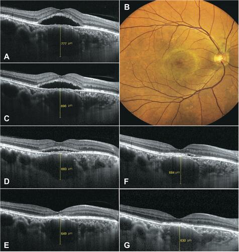 Figure 3 A chronic central serous chorioretinopathy (CSCR) patient who was later diagnosed with obstructive sleep apnea. (A and B) A 54-year-old obese man had been diagnosed with CSCR in the right eye for 6 months before the presentation. The presenting 24-hour urinary free cortisol (UFC) was 190 µg/day. (C and D) After receiving a 6-week course of ketoconazole, the choroidal thickness gradually decreased, (E) and CSCR resolved at 10 weeks post-treatment (UFC = 90 µg/day). (F) Six months later, CSCR recurred; the sleep laboratory revealed 34 episodes of apnea per hour. (G) The macula was dry after 6 weeks of airway ventilation therapy.