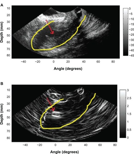 Figure 2 B-mode image (A) obtained during saline infusion sonohysterography in a 46-year-old woman with a diagnosis of an endometrial polyp and corresponding strain image (B) obtained using the 2-dimensional multilevel hybrid algorithm. Red arrows indicate the location of the polyp, and yellow contours indicate the outer uterine wall.