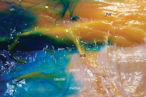 Figure 3 Lipomatous degeneration of the rectus abdominis muscle (“RA”) and restricted spread of the injectant in the cranial direction.