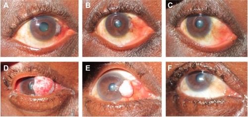 Figure 2 Clinical regression of OSSN in HIV-positive patients. (A–C) Photographs of patient 1 at presentation, and after three and four cycles of 5-FU, respectively. (D–F) Photographs of patient 13 at presentation, and after two cycles and three cycles of 5-FU, respectively.