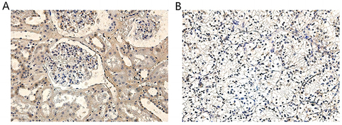 Figure 11 TSTD2 expression in cancer and adjacent tissues by Immunohistochemical staining: (A) high expression of TSTD2 protein (×200) in para-cancer tissue; (B) low expression of TSTD2 protein (×200) in cancer tissue.
