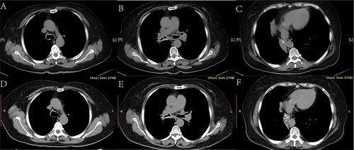 Figure 3 CT scan of the chest (soft tissue window) showing mediastinal windows before (A–C) and after treatment (D–F). (A–C) Soft tissue windows revealing the irregular thickening of tracheobronchial wall tissue accompanied by submucosal circumferential and granular calcification (A and B) and atelectatic lung tissue of the right middle and lower lobe with gathered bronchi outlined by the wall calcification (the bronchi are obstructed without air bronchogram sign) (C). (D–F) Soft tissue windows showing the relieved tracheobronchial wall thickening, luminal stenosis, and atelectasis of the right lower lobe; there was bronchial inflation sign in atelectasis.