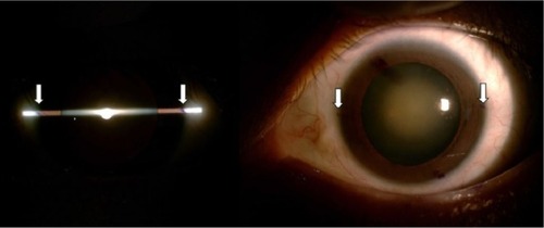 Figure 2 Perfect alignment of the horizontal slit beam marker (white arrow, thin blue dot).