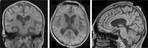 Figure 2 Images from the magnetic resonance imaging at the hemodialysis initiation.
