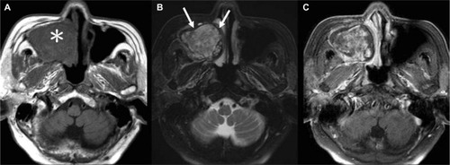 Figure 3 MR imaging of sinonasal angiomatous polyp.