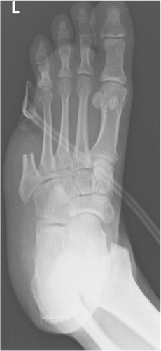 Fig. 1 Postoperative plain radiographs of the left foot showing the negative pressure wound therapy application over the surgical wound defect prior to the lesser toe fillet flap reconstruction. No osteomyelitis was noted on the preoperative plain radiograph of the left foot.