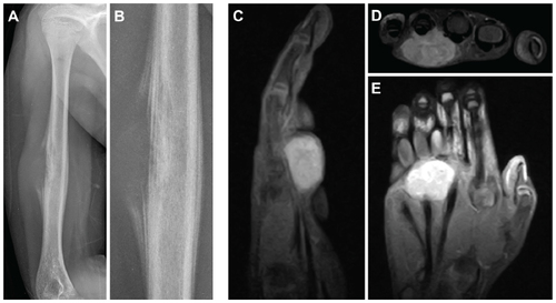 Figure 2 (A–E) Radiologic appearance of Ewing sarcomas.