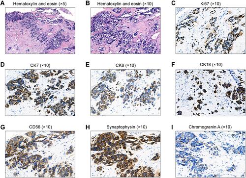 Figure 4 Histological analysis of the first external auditory canal biopsy. (A, B) Hematoxylin and eosin-stained slides showing some glandular structures in poorly differentiated tumor cells. (C–I) Immunohistochemical staining showing elevated proliferation rates (> 90% hotspot Ki-67) (C), and simultaneous expression of CK7 (D), CK8 (E), CK18 (F), CD56 (G), synaptophysin (H), and chromogranin A (I) in > 50% of the tumor cells. Magnifications: a, ×5; b–i, ×10.