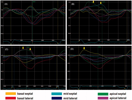 Figure 2. Dispersion of segmental longitudinal strain curves in the apical 4-chamber view with respect to the presence of mechanical dyssynchrony and myocardial scar. Each color-coded curve corresponds to one of six segments of septal and lateral walls, as indicated in the bottom of the figure. (A) Mechanical dyssynchrony in a patient with non-ischemic heart failure – classical pattern (Video 2A); early contraction of septal segments stretches lateral wall segments while the opposite can be seen in the late systole (“mirroring curves”); (B) Mechanical dyssynchrony in a patient with scarred mid (cyan) and apical (green) septal segments (Video 2B); basal septal segment shows typical dyssynchronous contraction pattern while the remaining two scarred segments are dyskinetic (positive curves) resulting in pronounced dispersion; (C) Dispersion of strain curves in a patient with no dyssynchrony and apical scar (Video 2C); (D) Dispersion of strain curves in a patient with no dyssynchrony and septal scar (Video 2D). AVC indicates aortic valve closure. Yellow arrows indicate positive strain curves of dyskinetic segments.