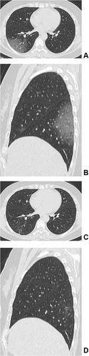 Figure 1 (A–D) Female, older patient of COVID-19. The initial CT at the hospital (A and B). The axial CT (A) and the sagittal CT (B) show the patchy ground-glass opacities (GGOs) under the subpleural area of the right middle lobe (B) and the right lower lobe (A and B). The follow-up CT obtained after 391 days (C and D). The axial follow-up CT (C) and the sagittal follow-up CT (D) show a few of GGOs and the irregular linear opacities remain under the subpleural area of the right lower lobe.