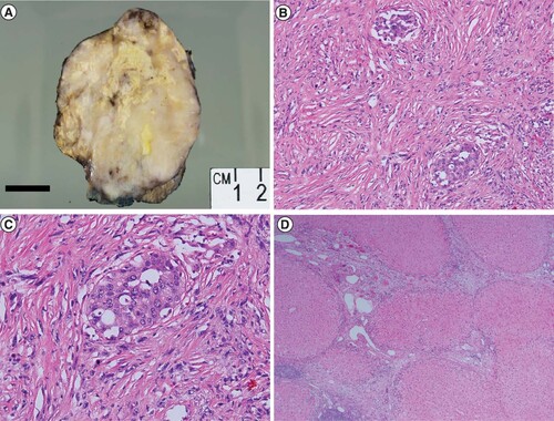 Figure 3. Gross and histologic findings of sarcomatoid hepatocellular carcinoma resection specimen.(A) A gross photograph of the resection specimen shows a variegated multinodular tumor with firm cream colored areas, yellow areas of necrosis that comprise about 25% of the tumor and areas of hemorrhage. Focal background cirrhotic liver is seen at the bottom right of the image. (B) Histologic examination of the patient’s resection specimen confirmed a predominantly sarcomatoid neoplasm with focal areas of conventional hepatocellular differentiation (H&E 100× magnification). (C) Higher magnification shows neoplastic epithelioid tumor cells surrounded by malignant spindled sarcomatoid cells (H&E 200 × magnification). (D) Cirrhotic background hepatic parenchyma (H&E × 40 magnification).