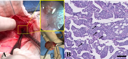 Figure 2. Gross morphological and histopathological features of the urinary bladder and proximal urethra in a dog with urethral transitional cell carcinoma. (A) The bladder mucosal wall was largely normal; however, a urethral multilobulated mass extending to the trigone area was identified (middle upper subset box). Bilateral enlarged sublumbar lymph nodes were excised in toto (middle lower picture). (B) Histopathology of the urethral mass revealed that it was composed of poorly demarcated, sessile, moderately to densely cellular, multifocally infiltrative neoplastic cells. Tumor cells were polygonal with a moderate amount of homogenous eosinophilic cytoplasm and distinct cell borders; occasionally, cells swollen due to the presence of discrete, large, clear, or eosinophilic vacuoles were observed (arrows). H&E; magnification 400×; scale bar = 50 µm. H&E, hematoxylin & eosin.