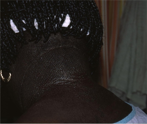 Figure 3 Lichenification from chronic eczema on the posterior neck.