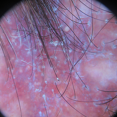 Figure 8 Trichoscopy of lichen planopilaris shows perifollicular scales and perifollicular and interfollicular erythema.