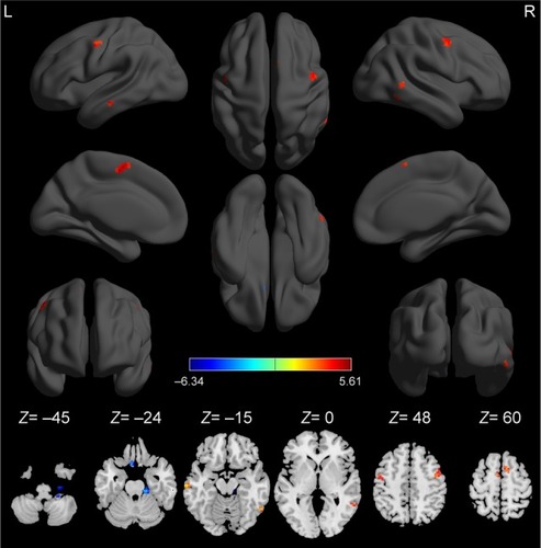 Figure 1 Compared to healthy controls, alcohol-dependent subjects showed altered ReHo areas.