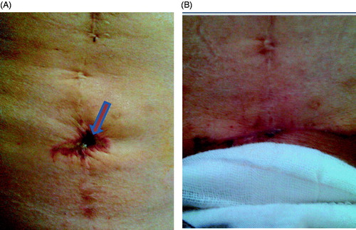 Figure 3. Pictures obtained from a 45-year-old adenomyotic patient with abdominal scar. (A) A picture obtained 2 days after HIFU shows a small area of third degree of skin burn on the surgical scar (arrow); the size of the burnt area was 1.0 × 1.5 cm (arrow). (B) Picture obtained two weeks after HIFU shows the burnt skin had been resected.