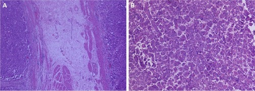 Figure 4 Gastric metastasis of ovarian serous cystadenocarcinoma ×50 (A); ×100 (B).