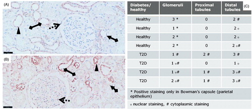 Figure 1. pSmad2 immunostainings of T2D patients vs. controls. pSmad2 immunostaining of kidneys from T2D patients compared to healthy donor kidneys. Representative IHC sections from a healthy donor kidney (A) and a T2D patient kidney (B) shown at 20X magnification where the black-line =50uM. Kidney sections show a glomerulus structure (dotted arrow), a proximal tubule (arrow connected to a diamond) and a distal tubule (diamond connected to diamond). Filled triangle indicates positively stained nuclei structure indicative of active signaling.